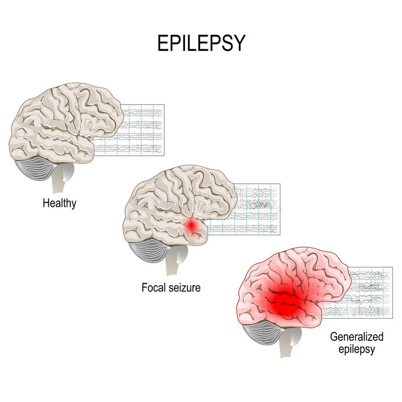 epilepsy-art.jpg